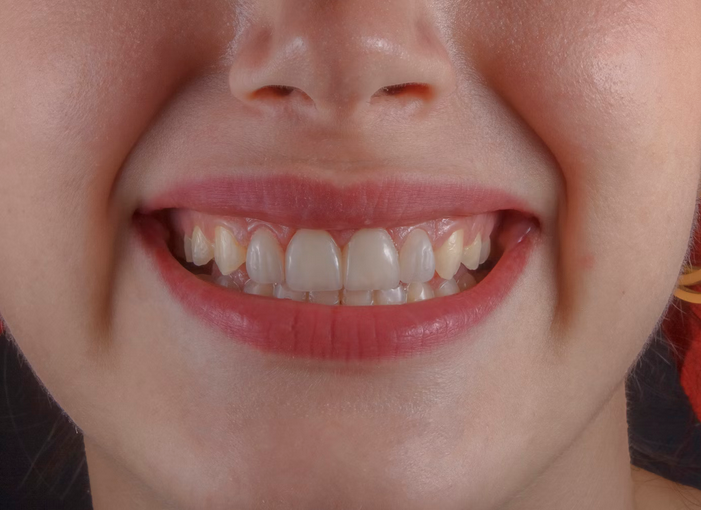 How to Whiten Your Teeth Naturally Without Damaging Enamel